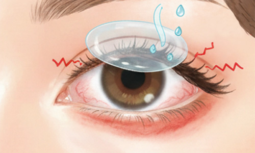 コンタクトレンズとドライアイの深い関係