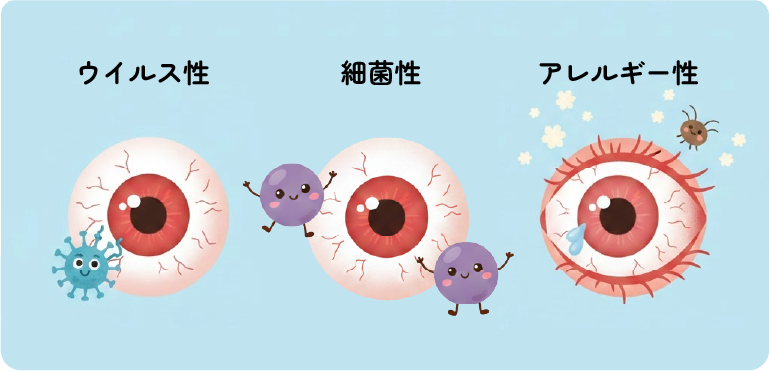 結膜炎のタイプ｜ウィルス性、細菌性、アレルギー性