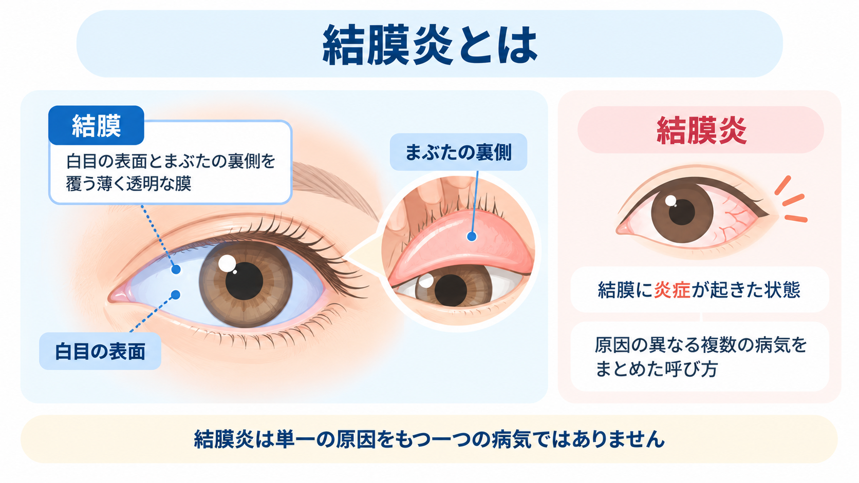 結膜炎とは
