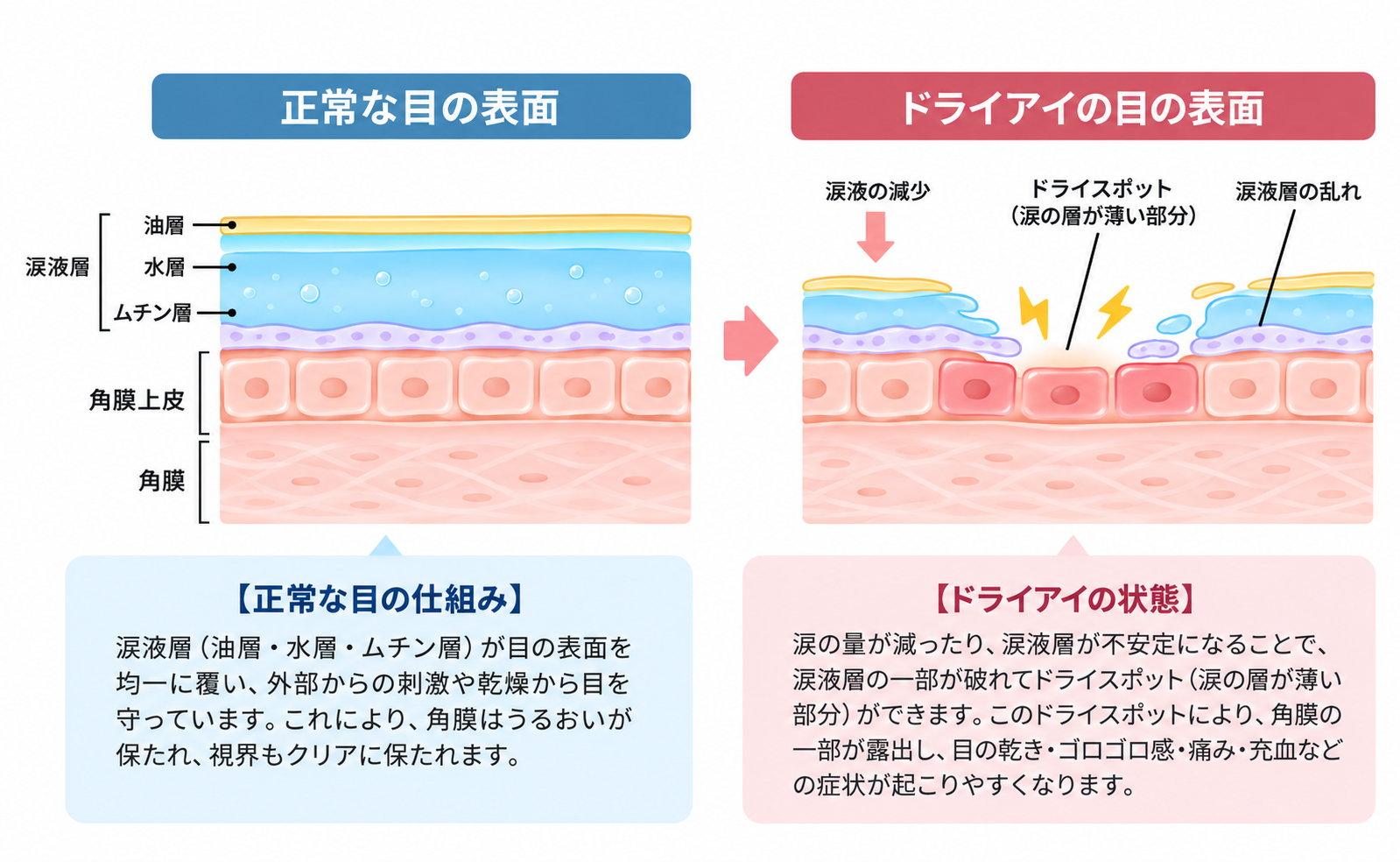 正常な涙・眼表面とドライアイの違い